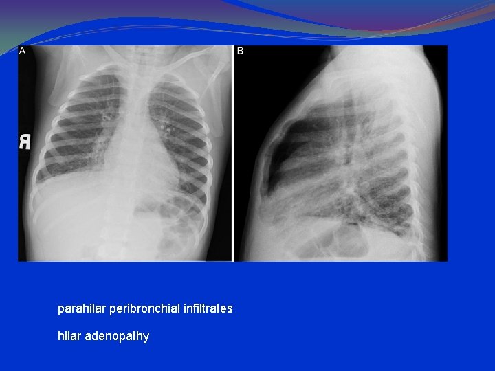 parahilar peribronchial infiltrates hilar adenopathy 