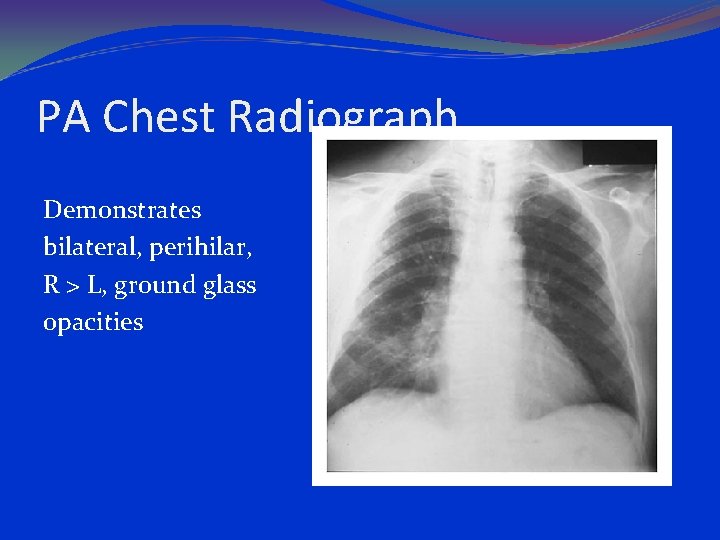 PA Chest Radiograph Demonstrates bilateral, perihilar, R > L, ground glass opacities 