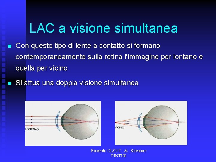 LAC a visione simultanea n Con questo tipo di lente a contatto si formano