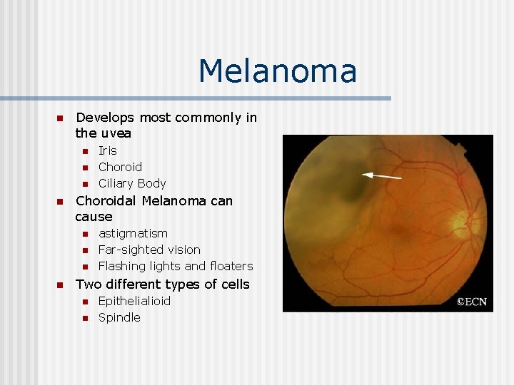 Melanoma n Develops most commonly in the uvea n n Choroidal Melanoma can cause