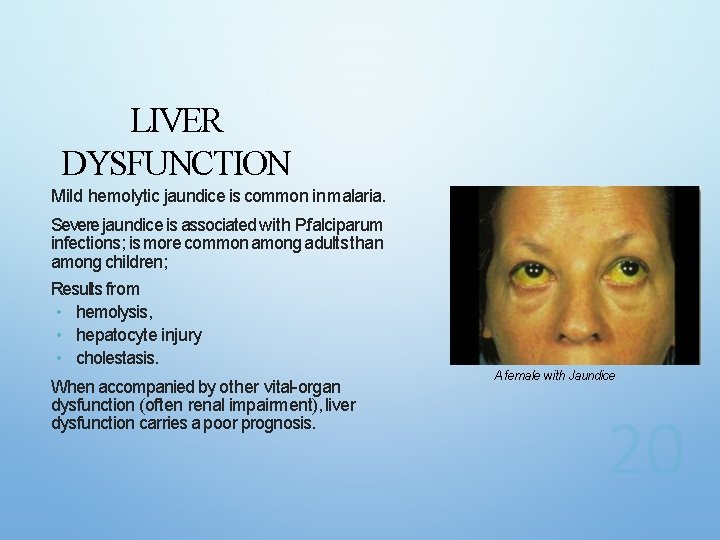 LIVER DYSFUNCTION Mild hemolytic jaundice is common in malaria. Severe jaundice is associated with