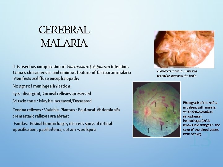 CEREBRAL MALARIA It is a serious complication of Plasmodium falciparum infection. Coma is characteristic