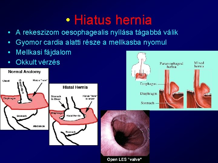  • Hiatus hernia • • A rekeszizom oesophagealis nyílása tágabbá válik Gyomor cardia