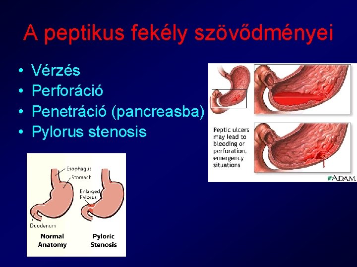 A peptikus fekély szövődményei • • Vérzés Perforáció Penetráció (pancreasba) Pylorus stenosis 