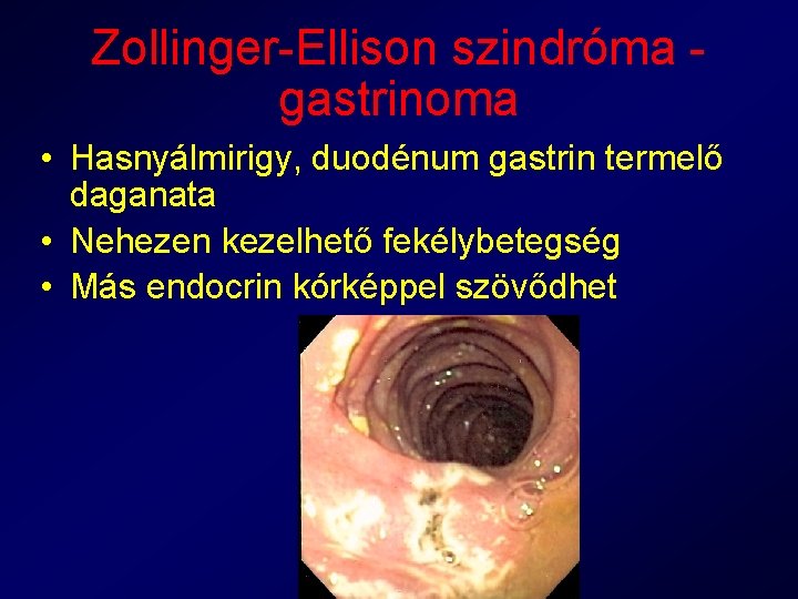 Zollinger-Ellison szindróma gastrinoma • Hasnyálmirigy, duodénum gastrin termelő daganata • Nehezen kezelhető fekélybetegség •