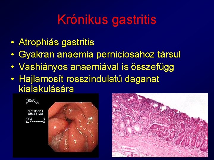 Krónikus gastritis • • Atrophiás gastritis Gyakran anaemia perniciosahoz társul Vashiányos anaemiával is összefügg