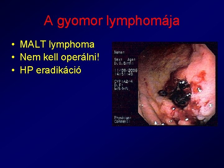 A gyomor lymphomája • MALT lymphoma • Nem kell operálni! • HP eradikáció 