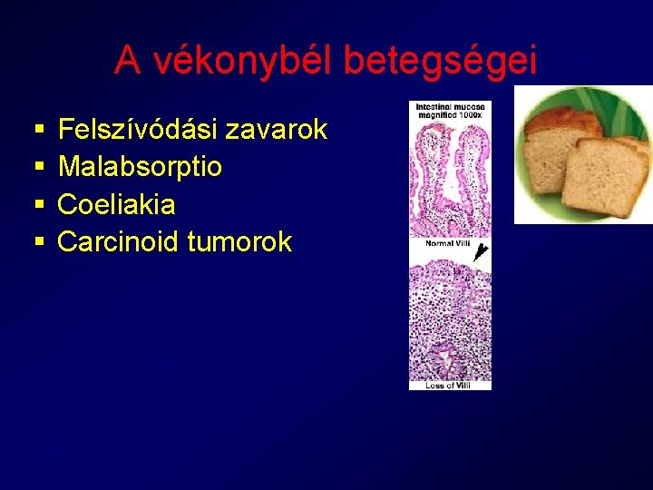 A vékonybél betegségei § § Felszívódási zavarok Malabsorptio Coeliakia Carcinoid tumorok 