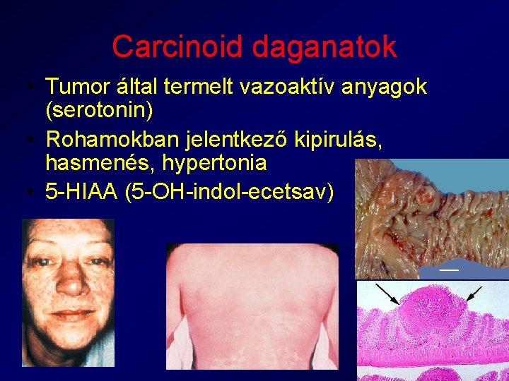 Carcinoid daganatok • Tumor által termelt vazoaktív anyagok (serotonin) • Rohamokban jelentkező kipirulás, hasmenés,