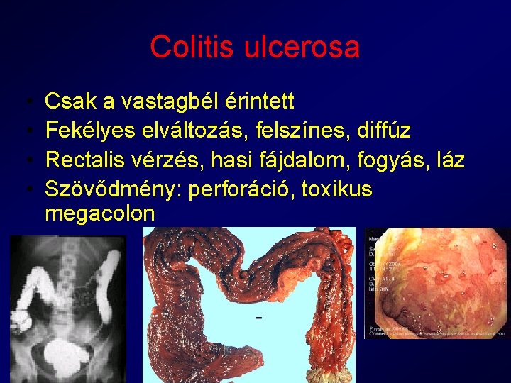 Colitis ulcerosa • • Csak a vastagbél érintett Fekélyes elváltozás, felszínes, diffúz Rectalis vérzés,