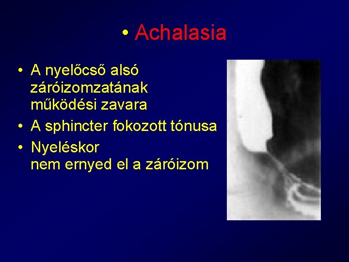  • Achalasia • A nyelőcső alsó záróizomzatának működési zavara • A sphincter fokozott