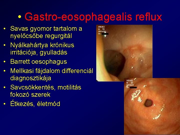  • Gastro-eosophagealis reflux • Savas gyomor tartalom a nyelőcsőbe regurgitál • Nyálkahártya krónikus