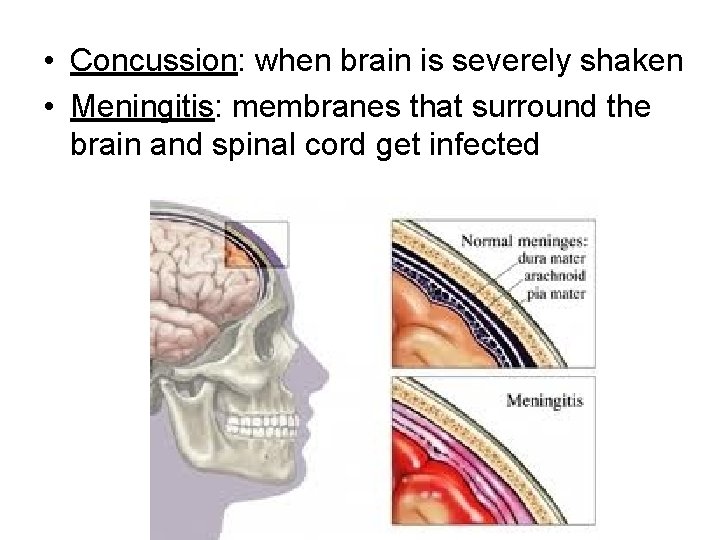  • Concussion: when brain is severely shaken • Meningitis: membranes that surround the