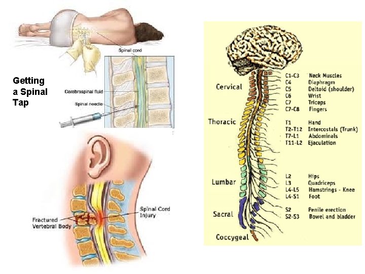 Getting a Spinal Tap 