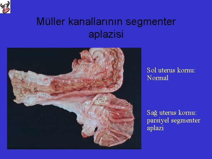 Müller kanallarının segmenter aplazisi Sol uterus kornu: Normal Sağ uterus kornu: parsiyel segmenter aplazi