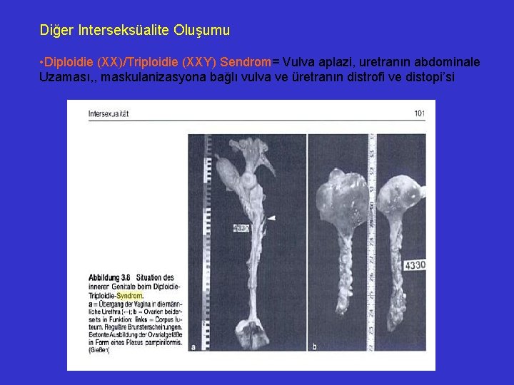 Diğer Interseksüalite Oluşumu • Diploidie (XX)/Triploidie (XXY) Sendrom= Vulva aplazi, uretranın abdominale Uzaması, ,