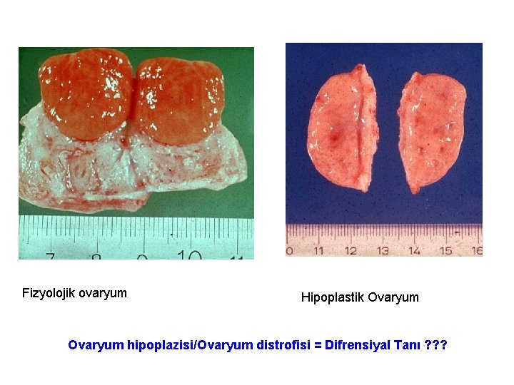 Fizyolojik ovaryum Hipoplastik Ovaryum hipoplazisi/Ovaryum distrofisi = Difrensiyal Tanı ? ? ? 