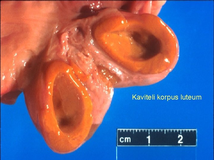 Kaviteli korpus luteum 