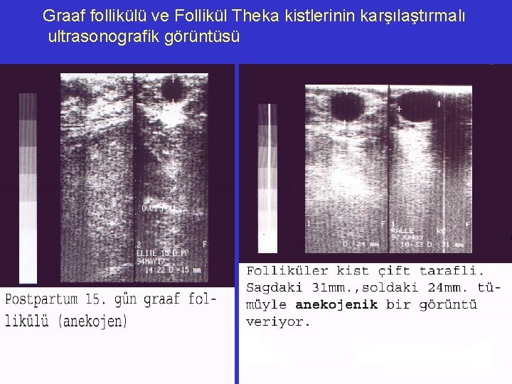 Graaf follikülü ve Follikül Theka kistlerinin karşılaştırmalı ultrasonografik görüntüsü 