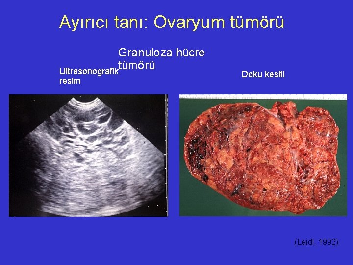 Ayırıcı tanı: Ovaryum tümörü Granuloza hücre tümörü Ultrasonografik resim Doku kesiti (Leidl, 1992) 