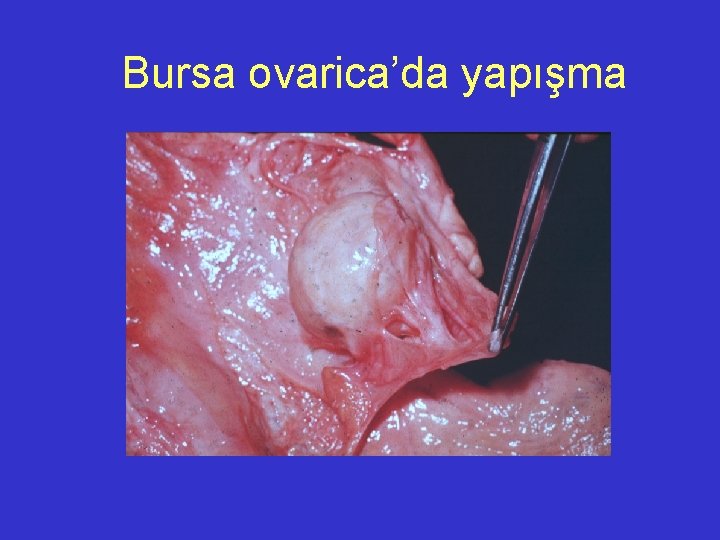  Bursa ovarica’da yapışma 