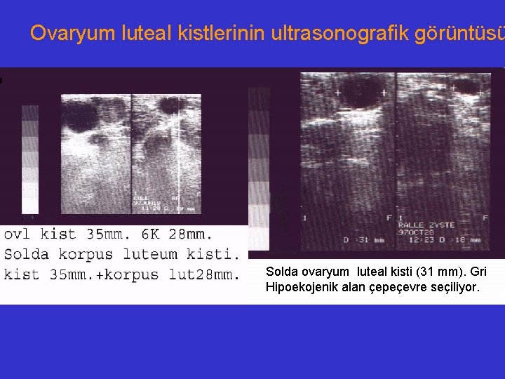 Ovaryum luteal kistlerinin ultrasonografik görüntüsü Solda ovaryum luteal kisti (31 mm). Gri Hipoekojenik alan