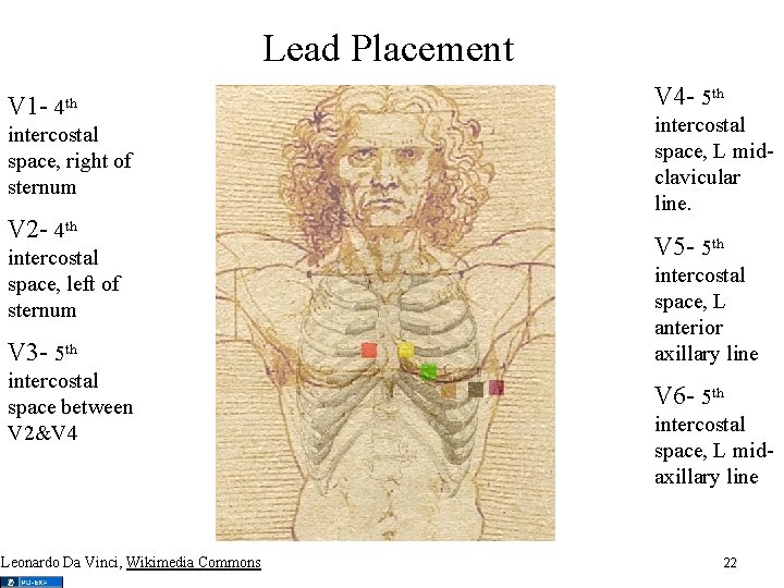 Lead Placement V 1 - 4 th intercostal space, right of sternum V 2