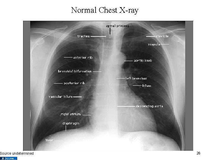 Source undetermined Normal Chest X-ray 26 