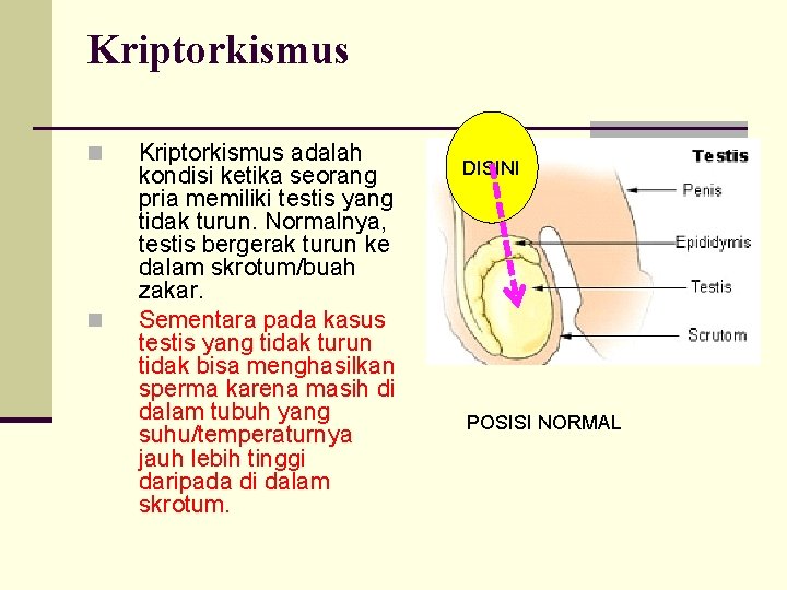 Kriptorkismus n n Kriptorkismus adalah kondisi ketika seorang pria memiliki testis yang tidak turun.