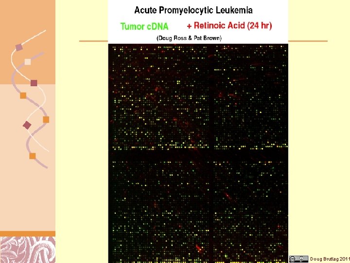 Diagnosis & Gene Expression Doug Brutlag 2011 