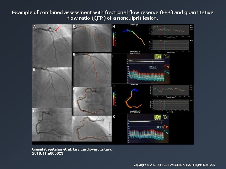 Example of combined assessment with fractional flow reserve (FFR) and quantitative flow ratio (QFR)