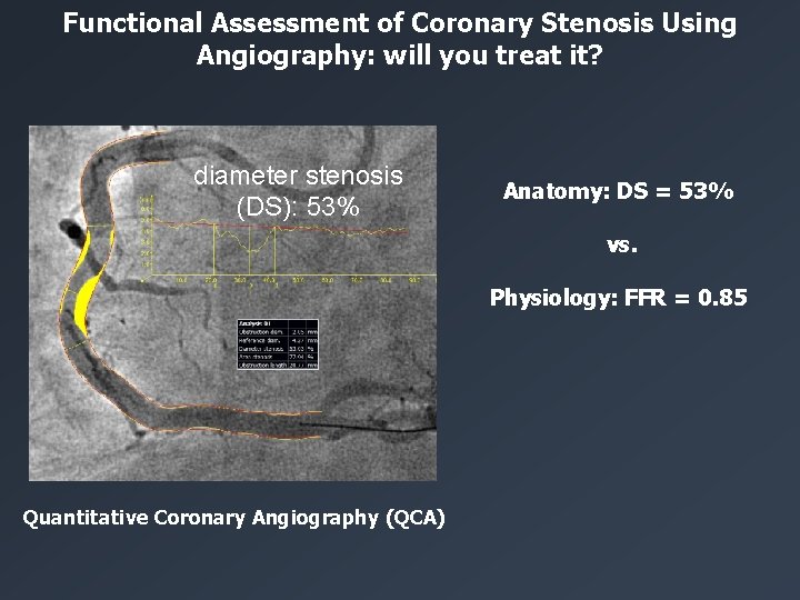 Functional Assessment of Coronary Stenosis Using Angiography: will you treat it? diameter stenosis (DS):