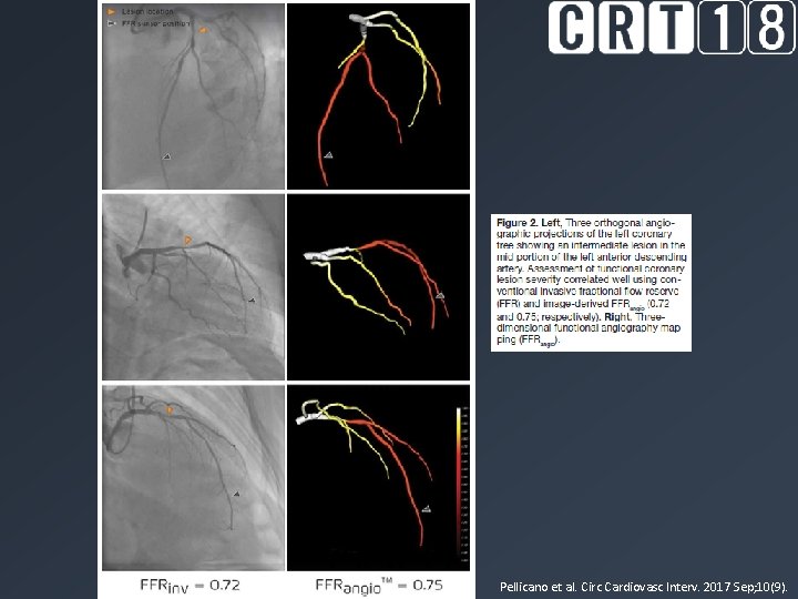 Pellicano et al. Circ Cardiovasc Interv. 2017 Sep; 10(9). 
