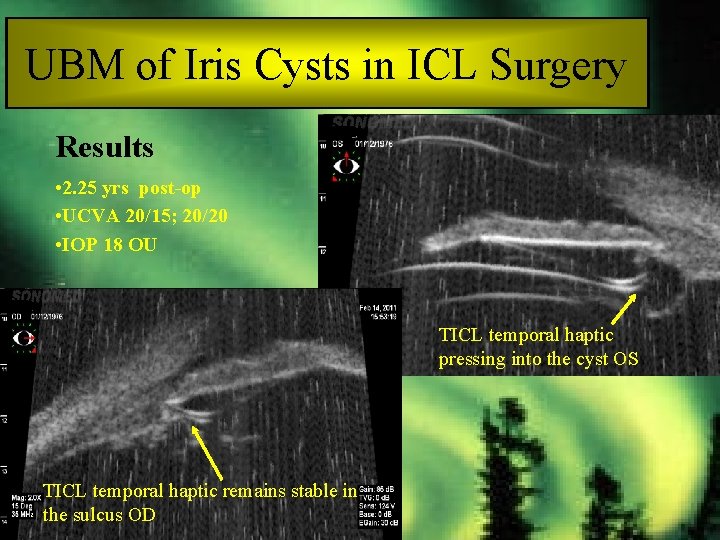 UBM of Iris Cysts in ICL Surgery Results • 2. 25 yrs post-op •