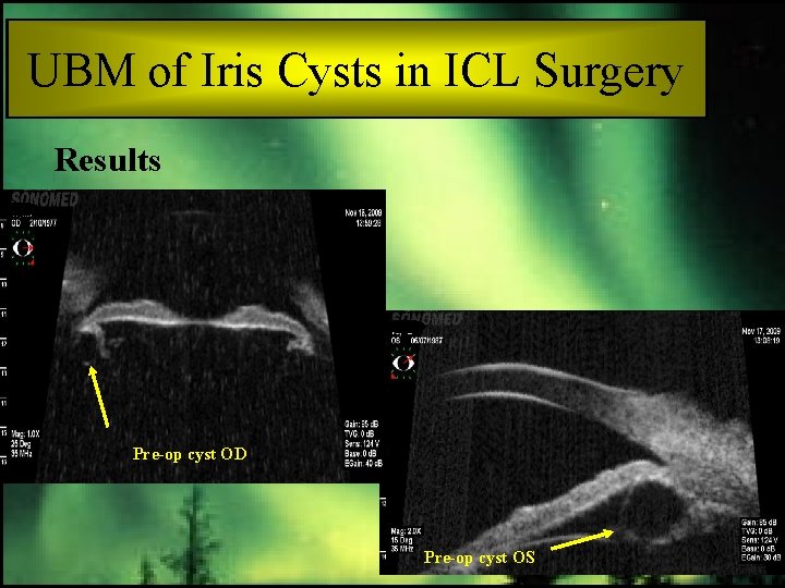 UBM of Iris Cysts in ICL Surgery Results Pre-op cyst OD Pre-op cyst OS