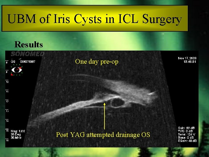 UBM of Iris Cysts in ICL Surgery Results One day pre-op Post YAG attempted