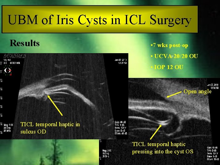 UBM of Iris Cysts in ICL Surgery Results • 7 wks post-op • UCVA