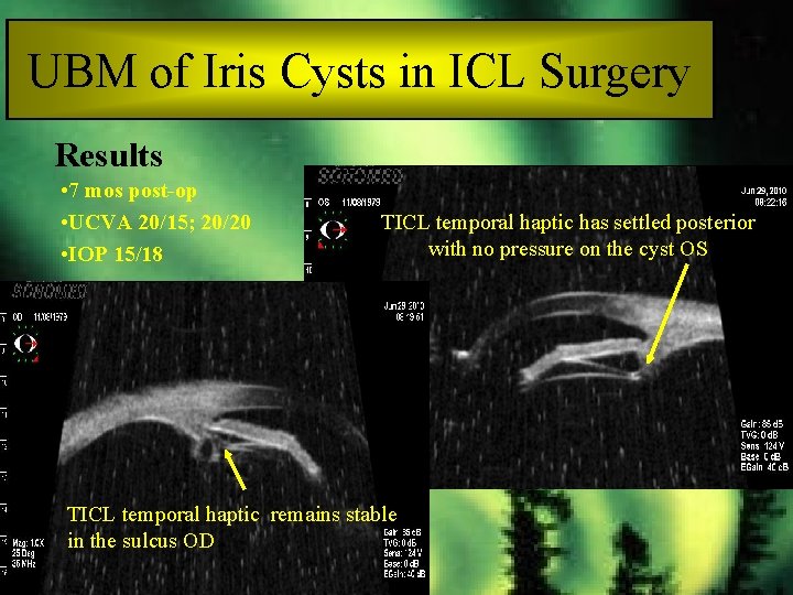 UBM of Iris Cysts in ICL Surgery Results • 7 mos post-op • UCVA