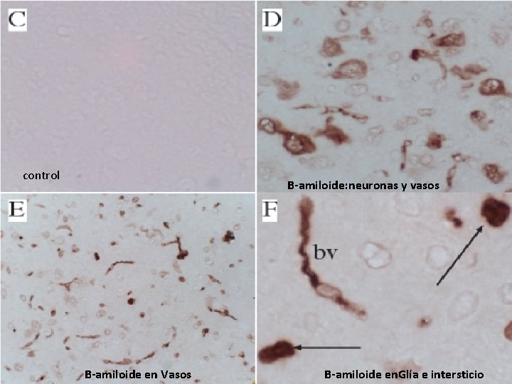 control B-amiloide: neuronas y vasos B-amiloide en Vasos B-amiloide en. Glía e intersticio 