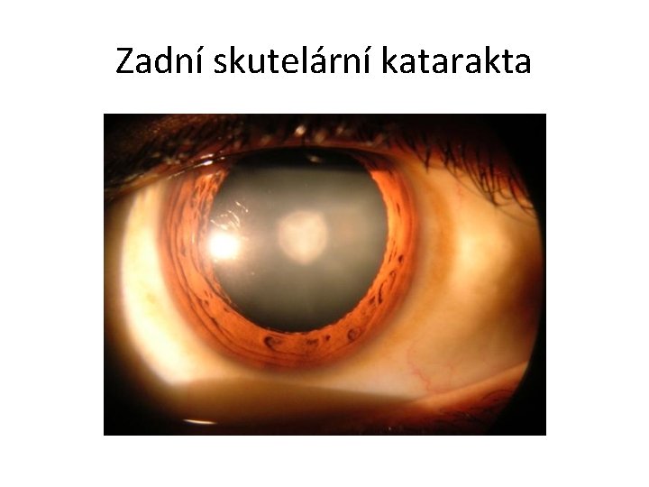 Zadní skutelární katarakta 