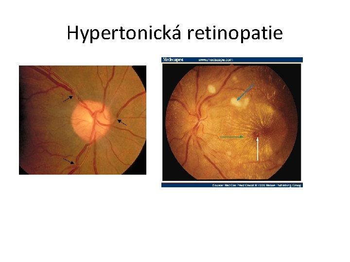 Hypertonická retinopatie 