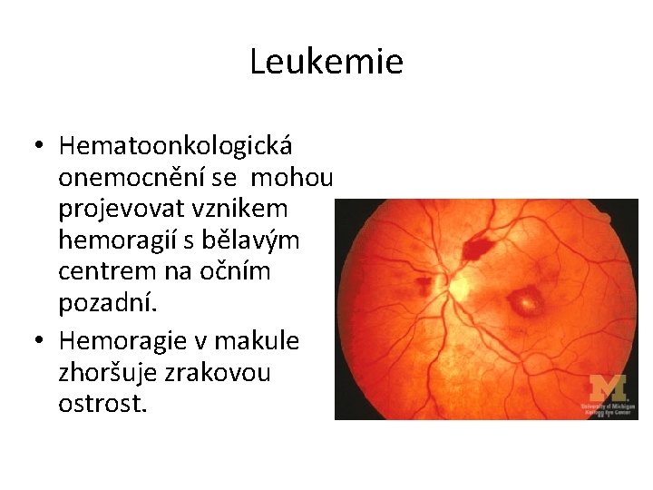Leukemie • Hematoonkologická onemocnění se mohou projevovat vznikem hemoragií s bělavým centrem na očním