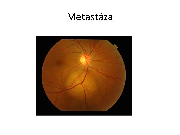 Metastáza 