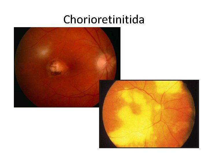 Chorioretinitida 
