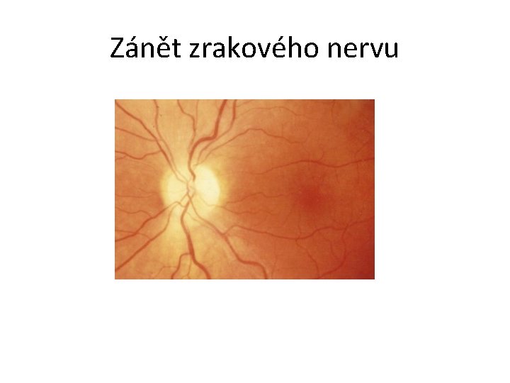 Zánět zrakového nervu 