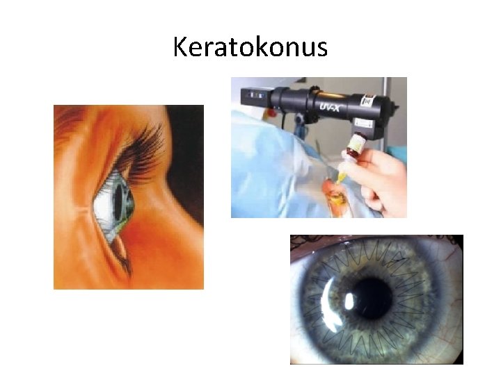 Keratokonus 