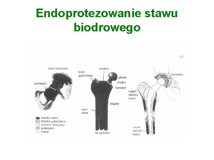 Endoprotezowanie stawu biodrowego 