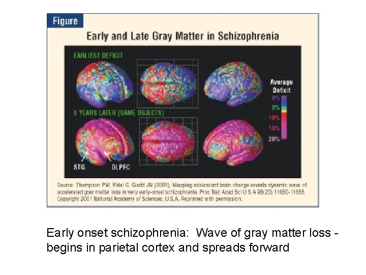 Early onset schizophrenia: Wave of gray matter loss begins in parietal cortex and spreads