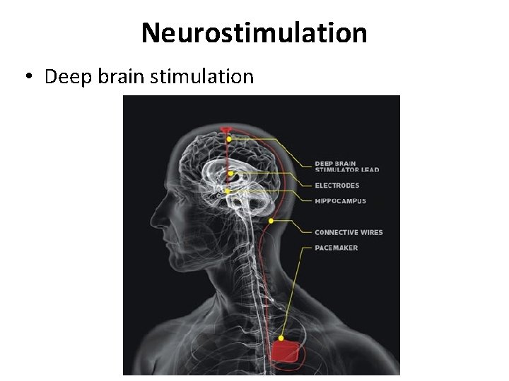 Neurostimulation • Deep brain stimulation 