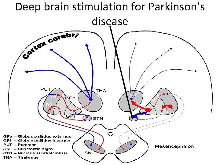 Deep brain stimulation for Parkinson’s disease 